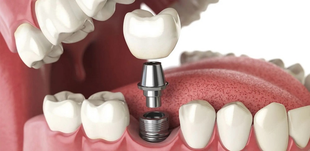 Morita Implant Center