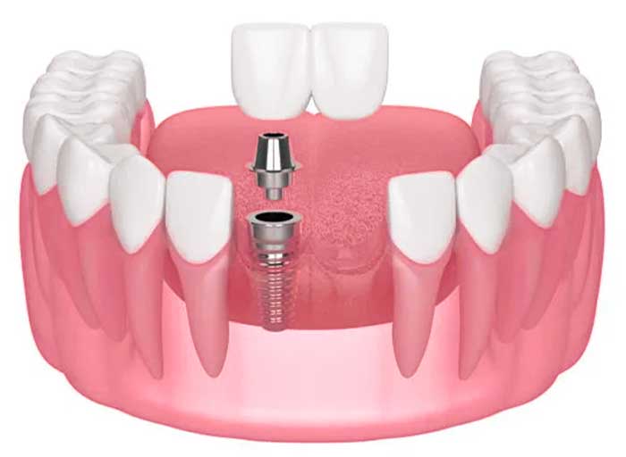 Morita Implant Center