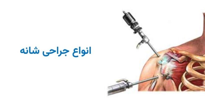 انواع جراحی شانه