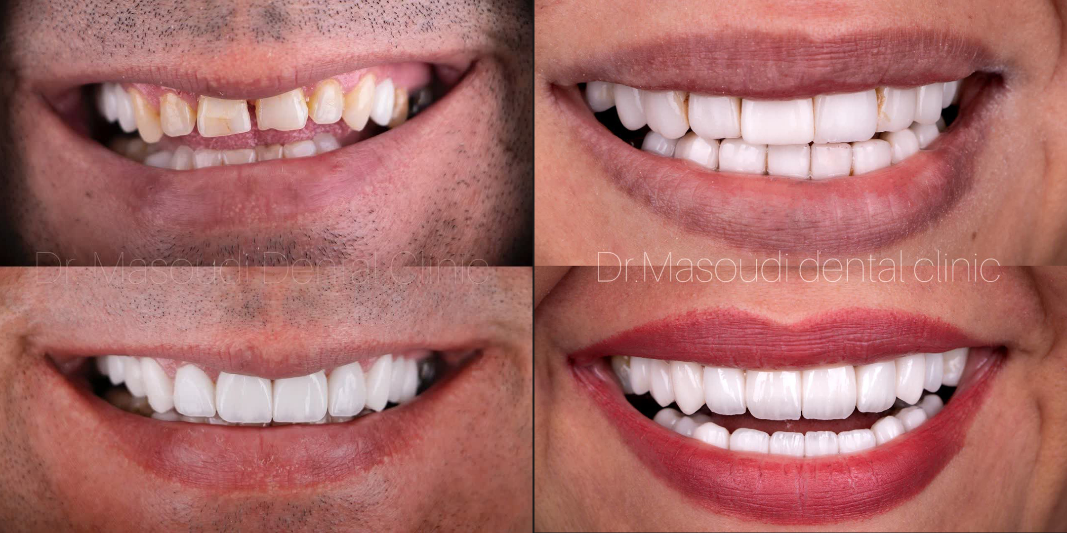 نمونه کار لمینت دندان