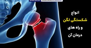 انواع شکستگی لگن و راه های درمان آن