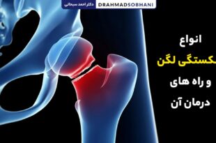انواع شکستگی لگن و راه های درمان آن