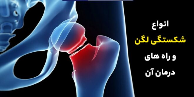 انواع شکستگی لگن و راه های درمان آن