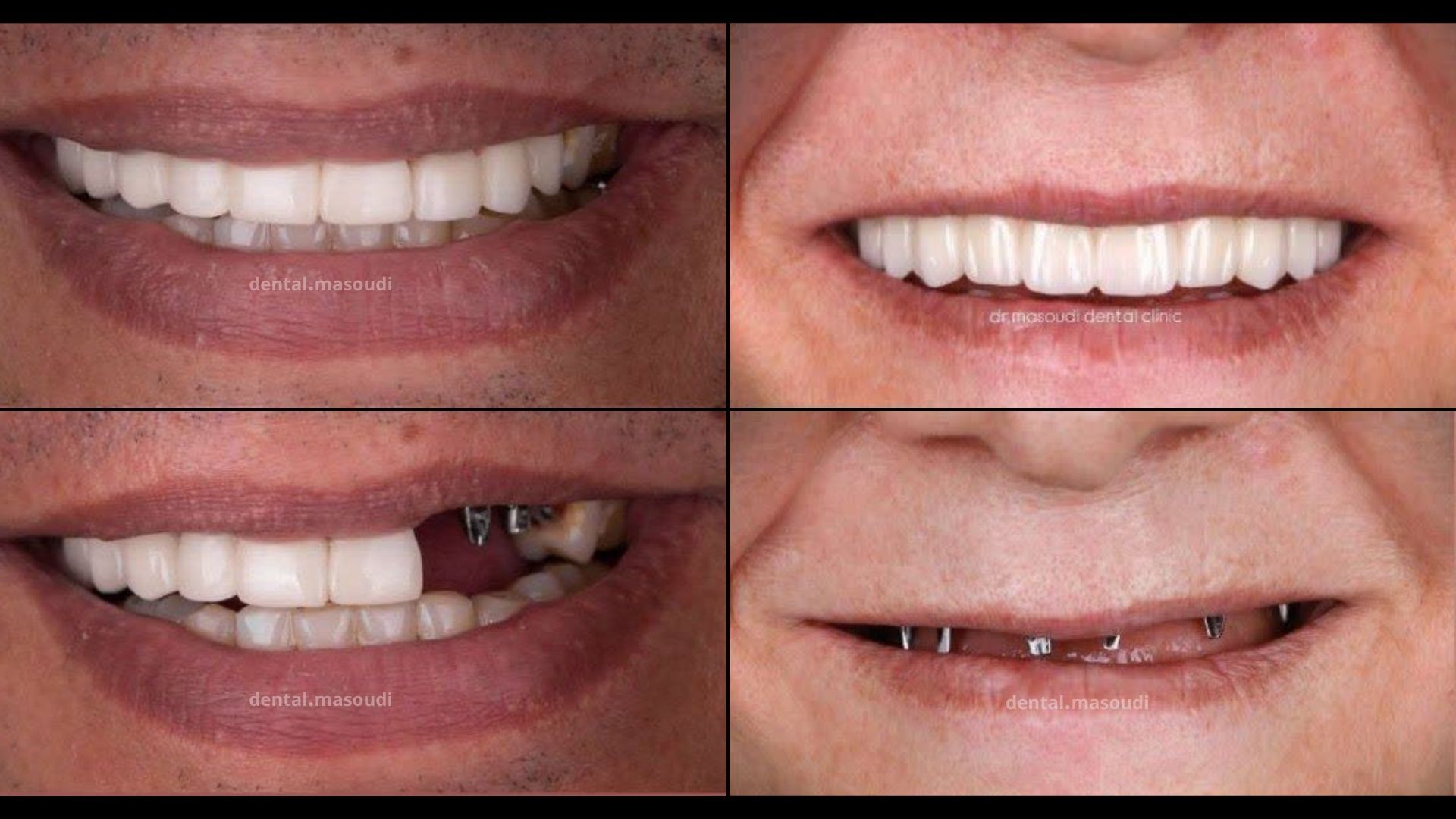 نمونه کار ایمپلنت دندان