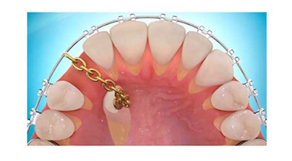 بیرون کشیدن دندان نهفته با ارتودنسی