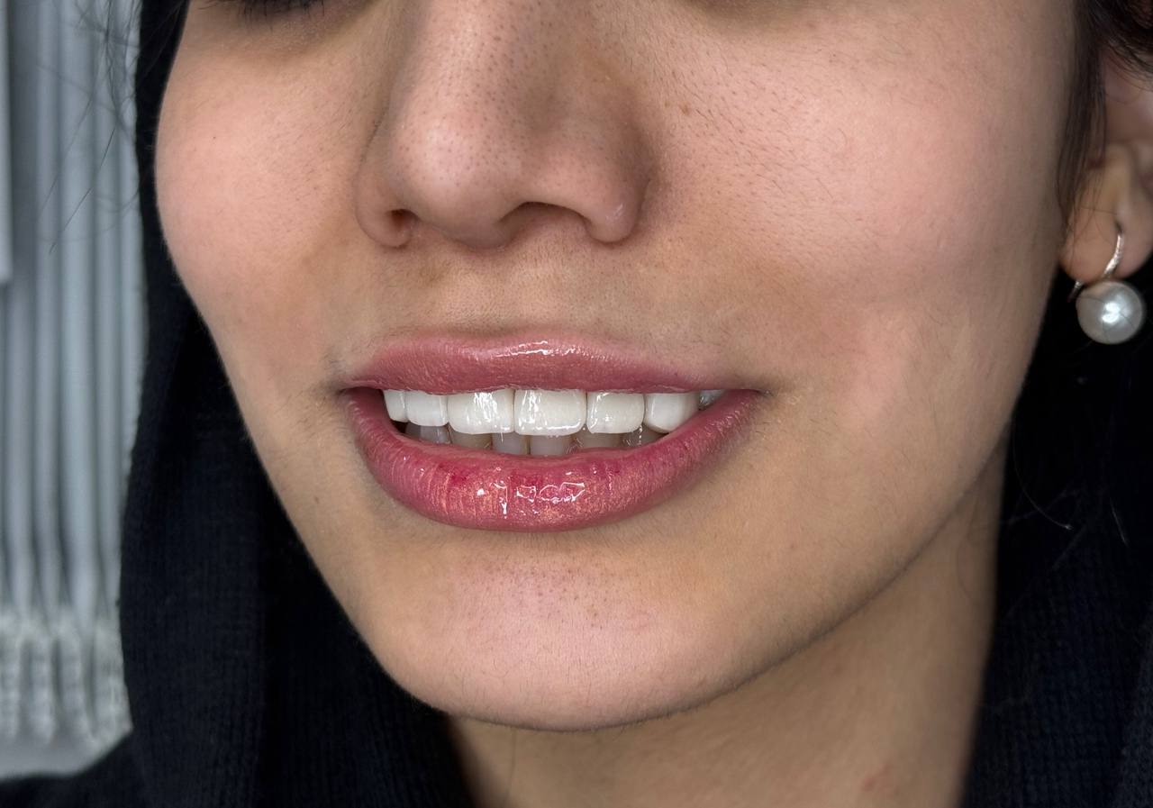 لبخند سفید و بینقص با لمینت یا کامپوزیت؟ بهترین انتخاب برای شما چیست؟ لبخند سفید و بینقص با لمینت یا کامپوزیت