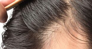 آیا امکان کاشت مو بدون تراشیدن سر وجود دارد؟