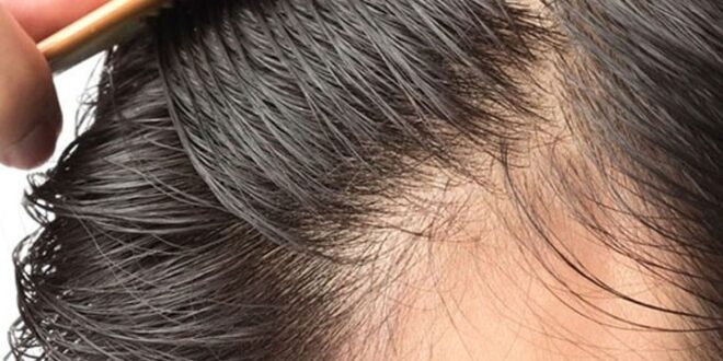 آیا امکان کاشت مو بدون تراشیدن سر وجود دارد؟