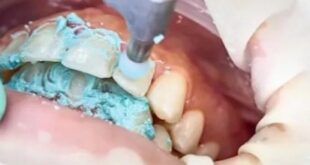 پولیش دندان بعد از ارتودنسی