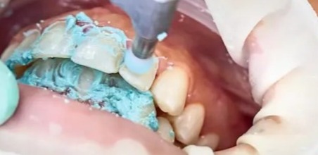 پولیش دندان بعد از ارتودنسی