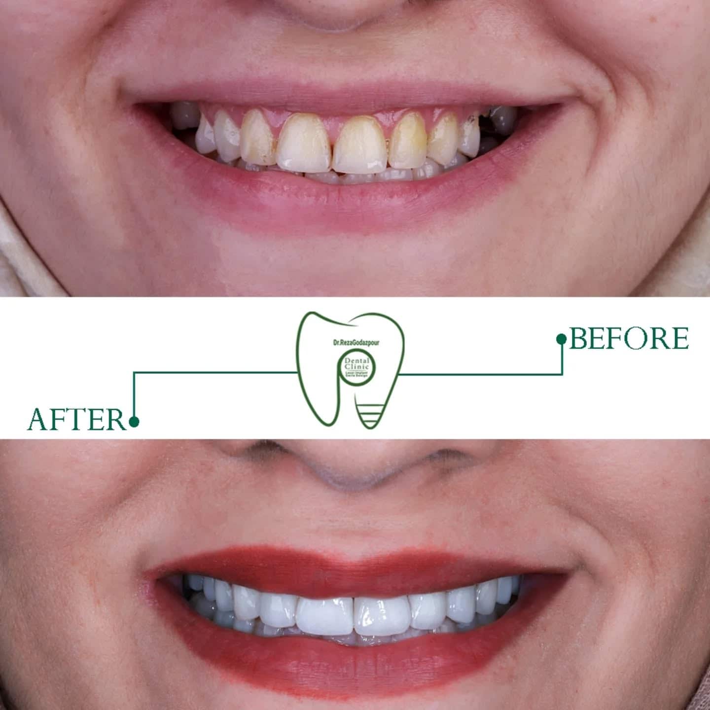 لبخند سفید و بینقص با لمینت یا کامپوزیت؟ بهترین انتخاب برای شما چیست؟ قبل و بعد لبخند لمینت یا کامپوزیت