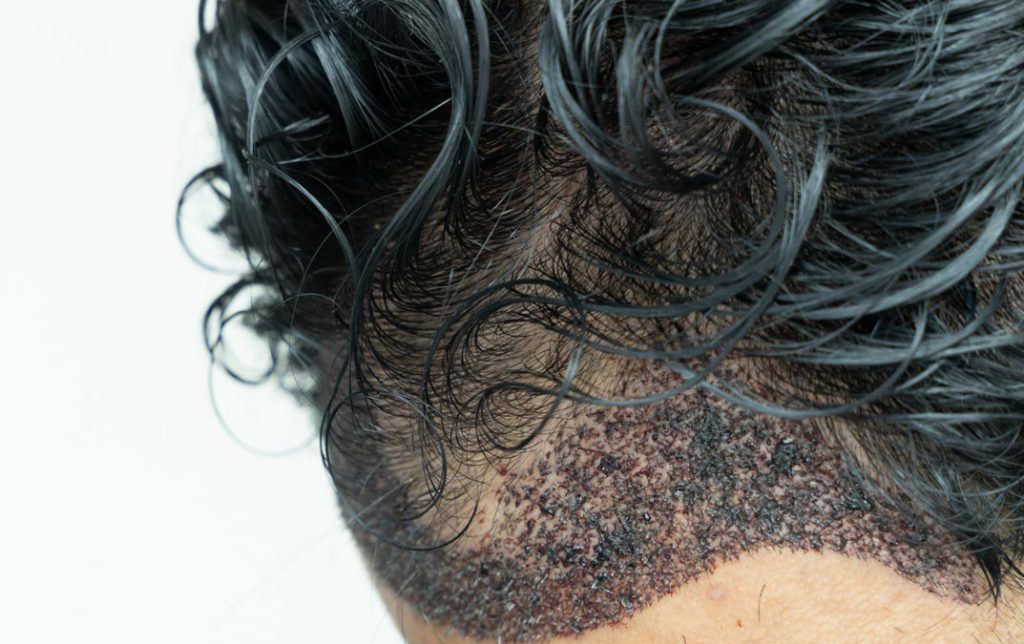 کاشت مو بدون تراشیدن سر برای چه افرادی مناسب است؟