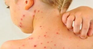 افزایش موارد ابتلا به سرخک در جهان با کاهش میزان واکسیناسیون