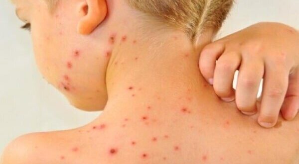 افزایش موارد ابتلا به سرخک در جهان با کاهش میزان واکسیناسیون