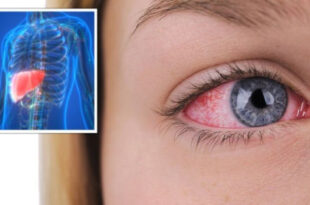 اگر چشمانتان این‌گونه به نظر برسد، کبدتان در خطر است