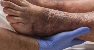 بی‌دردی زخم در افراد دیابتی نشانه پیشرفت آسیب عصبی است