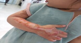 توصیه‌هایی برای پیشگیری از سوختگی