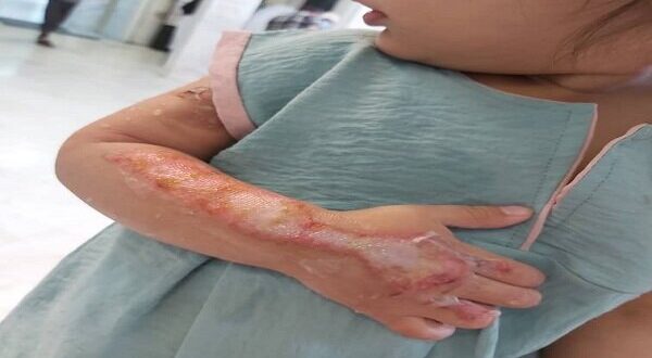 توصیه‌هایی برای پیشگیری از سوختگی