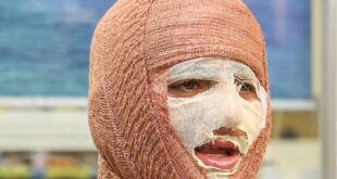 جلالی: سالانه حدود ۳۰۰ هزار نفر به مراکز سوختگی کشور مراجعه می‌کنند