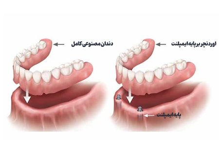 کاشت ایمپلنت دندان سالمندان