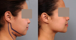 ساکشن غبغب چیست؟ صفر تا صد یک عمل ۴۵ دقیقه‌ای که خط فک را برمی‌گرداند