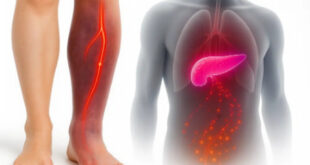 هشدار؛ اگر پاهایتان این ۴ علامت را دارد، ممکن است سرطان پانکراس باشد!