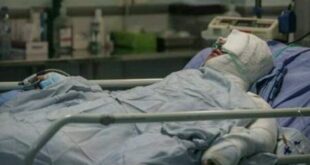 ۸۵ درصد سوختگی‌ها با روش‌های ساده قابل پیشگیری است