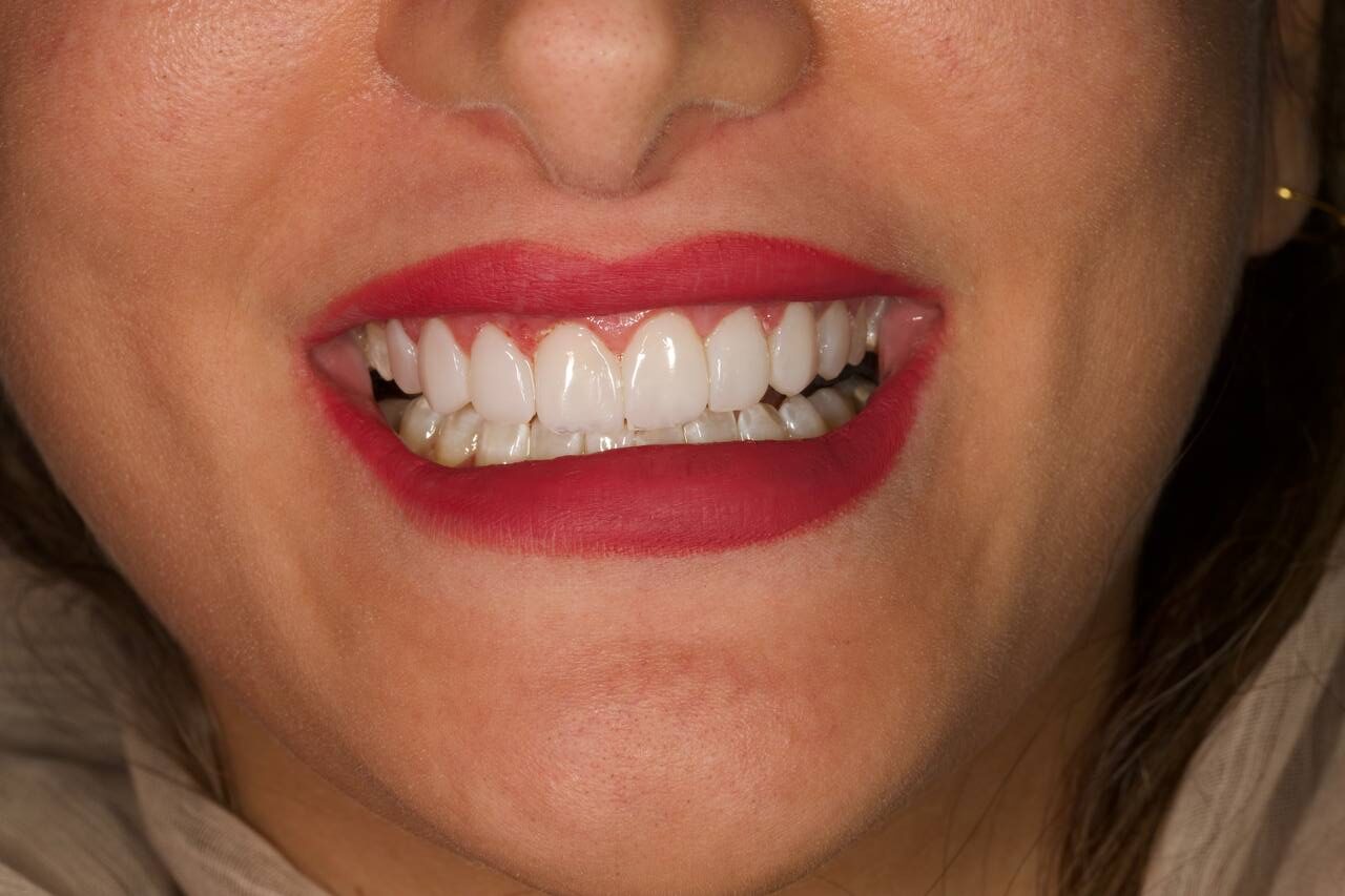 لبخند سفید و بینقص با لمینت یا کامپوزیت؟ بهترین انتخاب برای شما چیست؟ لبخند سفید و بینقص با لمینت یا کامپوزیت