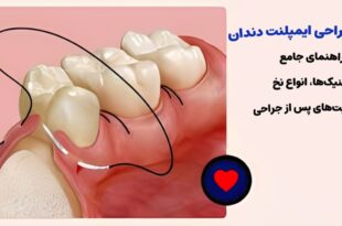 بخیه در جراحی ایمپلنت دندان