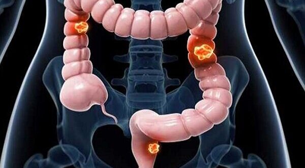 عوامل ابتلا به سرطان روده بزرگ را بشناسیم