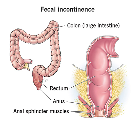بی‌اختیاری مدفوع پس از زایمان, علائم بی‌اختیاری مدفوع