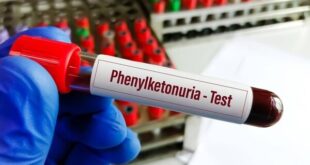 خبر خوش برای بیماران PKU؛ توزیع نان فاقد پروتئین