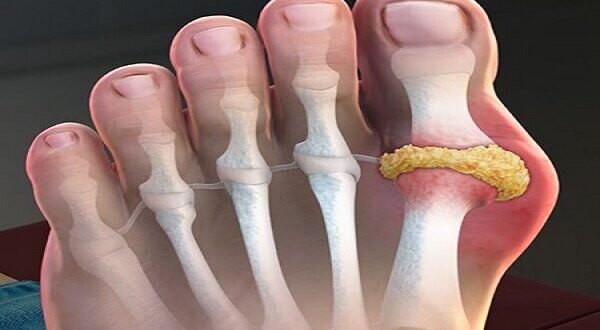 داروهای نقرس به سلامت قلب نیز کمک می‌کنند