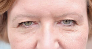 مشکلات رایج پلک که با افزایش سن ظاهر می‌شوند + درمان آن‌ها
