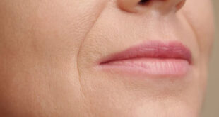 چاره چروک دور لب ها چیست؟