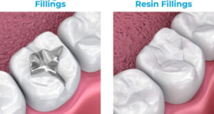 کدام پرکننده دندان ماندگارتر است؟ آمالگام یا کامپوزیت؟