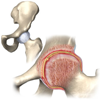 آرتروز زانو, سیستم‌ایمنی بدن, علایم آرتریت عفونی