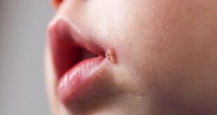 تفاوت آفت و تبخال در کودکان