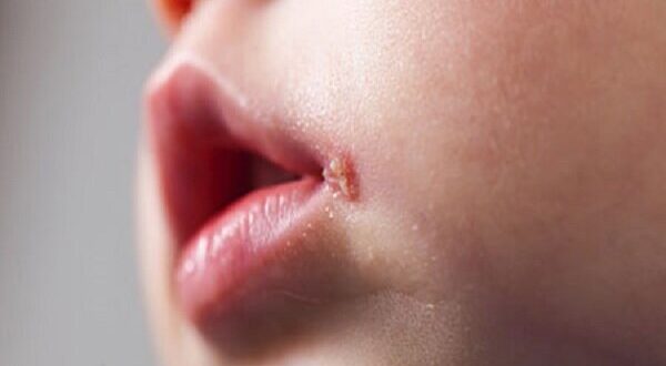 تفاوت آفت و تبخال در کودکان