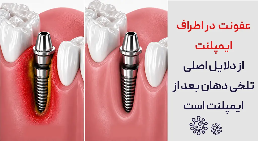 تلخی دهان بعد از ایمپلنت در اثر عفونت