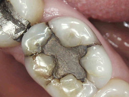 مواد پرکننده آمالگام