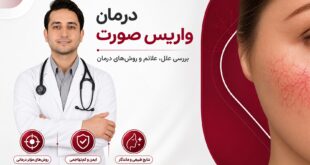درمان واریس صورت