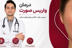 درمان واریس صورت