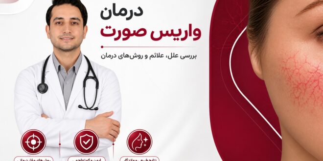 درمان واریس صورت