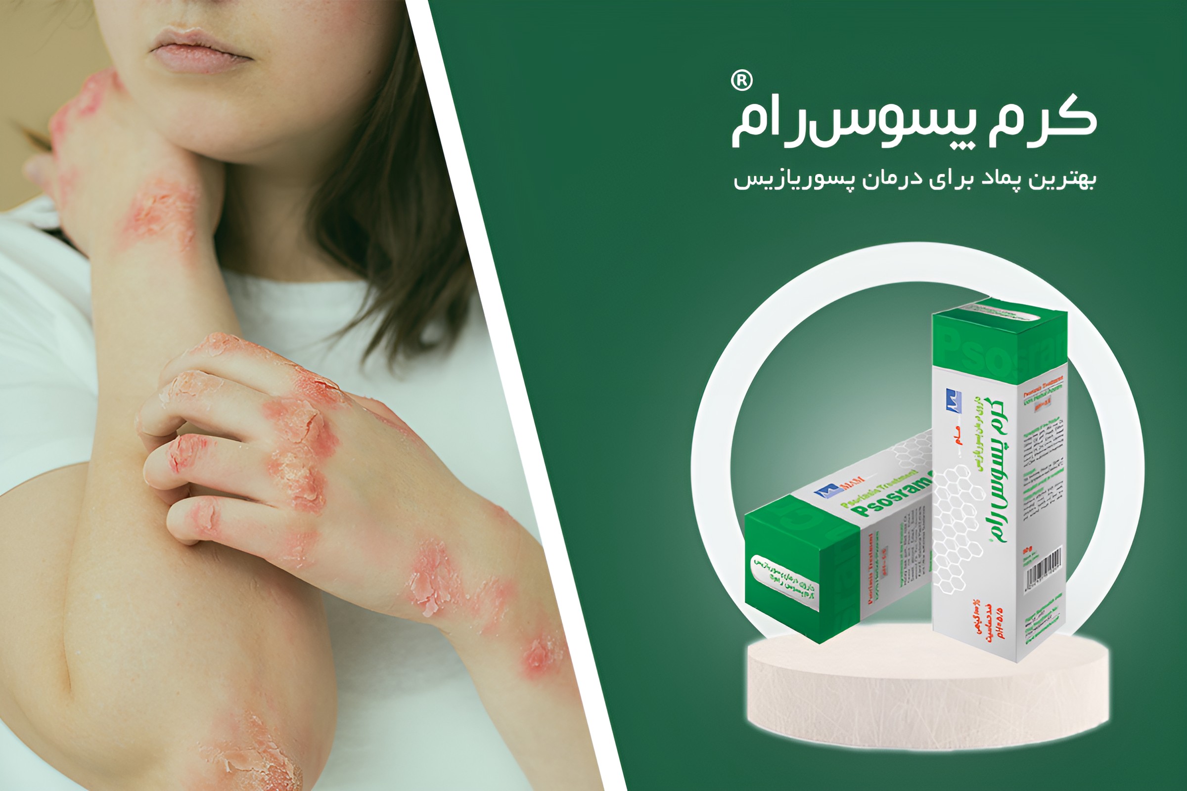 کرم گیاهی پسوس رام ؛ معروف به قاتل پسوریازیس