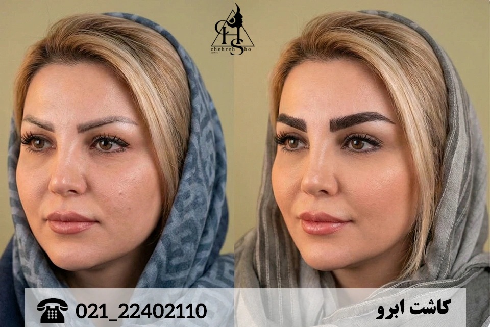 بهترین مدل کاشت ابرو بر اساس فرم صورت شما (گرد، کشیده، بیضی) تاثیر مدل کاشت ابرو